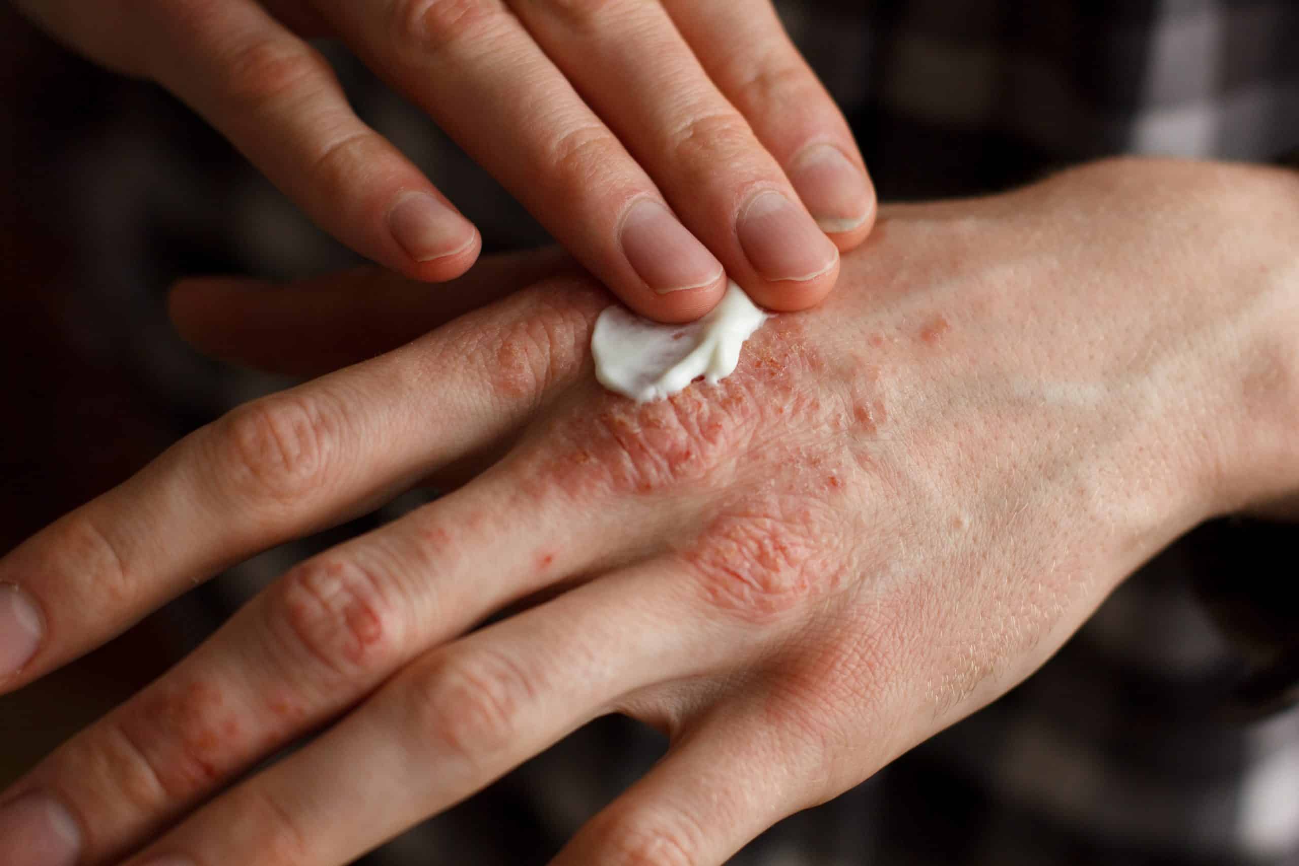 "applying psoriasis eczema treatment cream to dry skin"