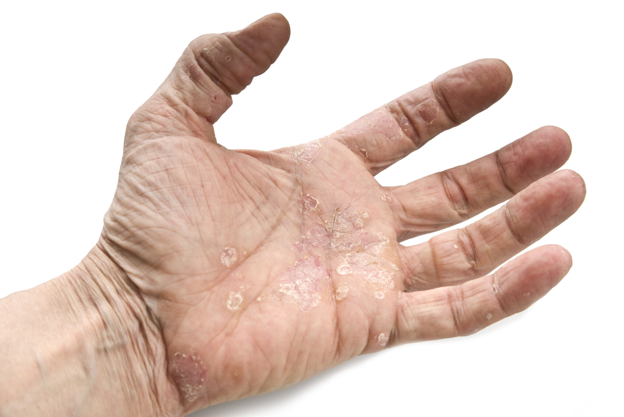 Psoriasis On The Hands And Feet M Folia